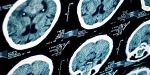 What Tests Should Doctors Perform to Diagnose Traumatic Brain Injury? Photo